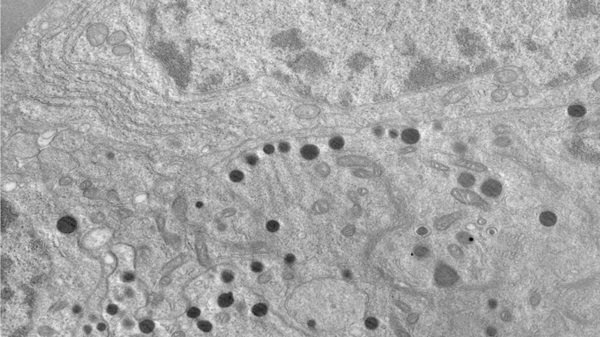 Células tumorales de pacientes con tumor somatotropo observadas mediante microscopio electrónico de transmisión.