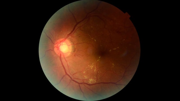 Una retina procesadas a través de Retinar. Foto: Agencia NA (CONICET).